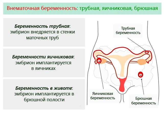 признаки беременности