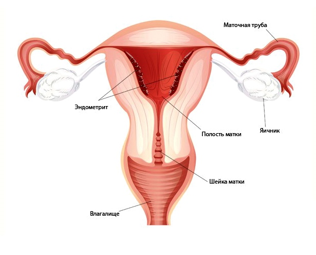 Матка воспалена Воспаление матки после родов