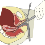Причины выскабливания матки Выскабливание и чистка матки