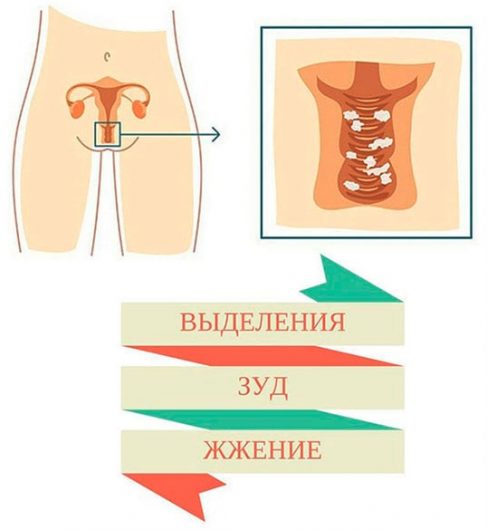 выделения .зуд. жжение