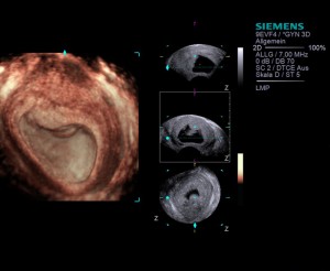 Плод замер УЗИ плода