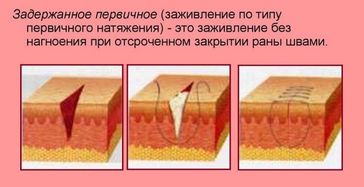 заживление ран