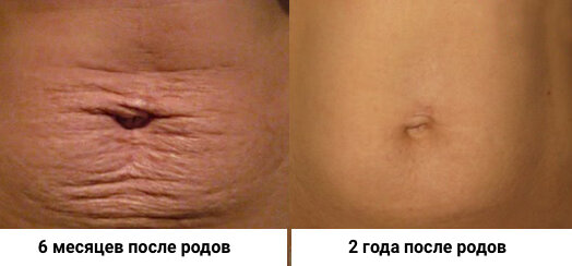 живот после родов
