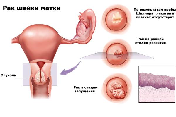 стадии новообразований в полости детородного органа