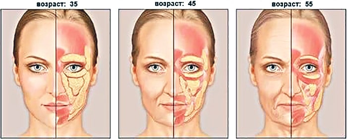 свисание жира в бульдожьи щечки