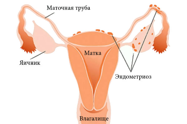 эндометриоз