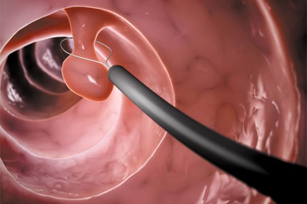 операция по удаления выроста на слизистой