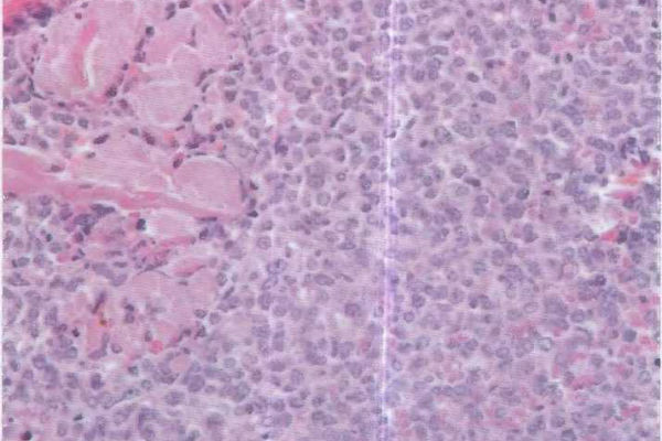 атипичные клетки