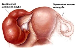 воспаленные фаллопиевы трубы