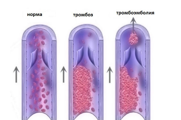 тромбофлебит
