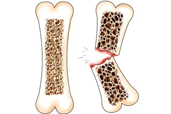 картинка здоровая и сломанная кость
