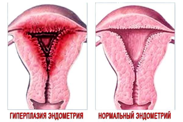 гиперплазия