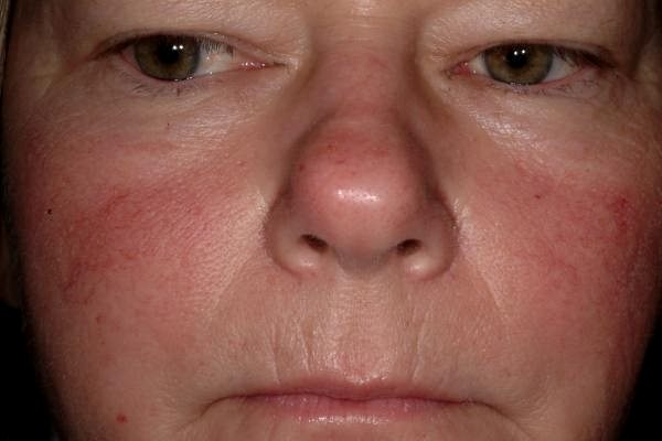 у дамы покраснение лица и звездочки