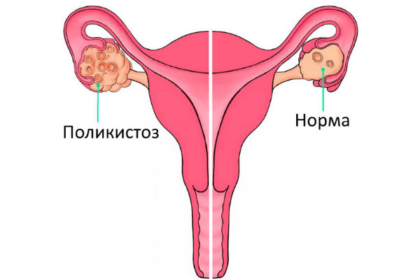поликистоз яичников