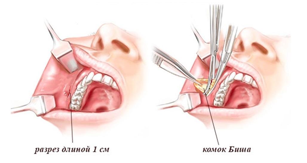 удалегние комка биша
