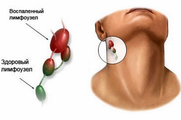воспаленный лимфоток