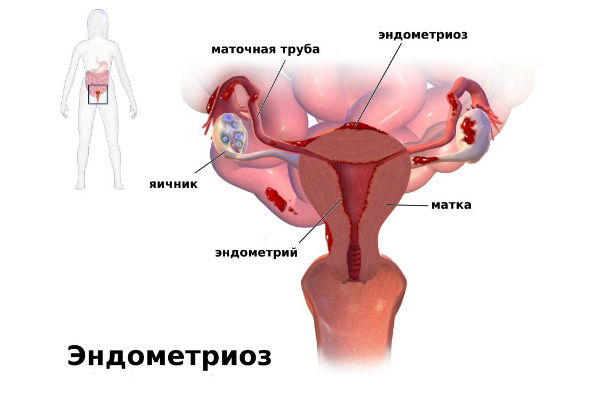 эндометриоз