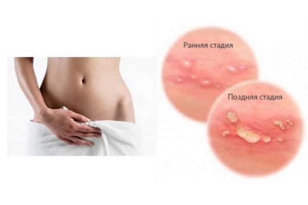 женское тело и стадии герпетической сыпи