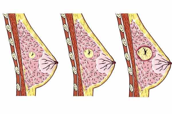 развитие кисты в груди