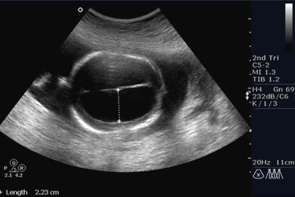 жидкость на узи в маточной полости