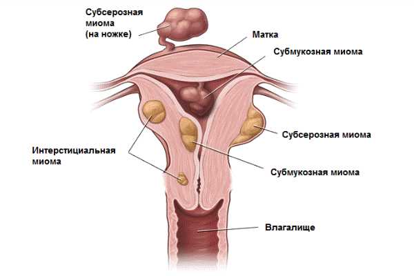 миома