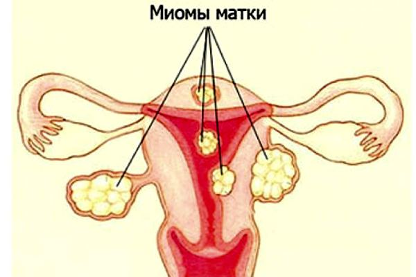 миома