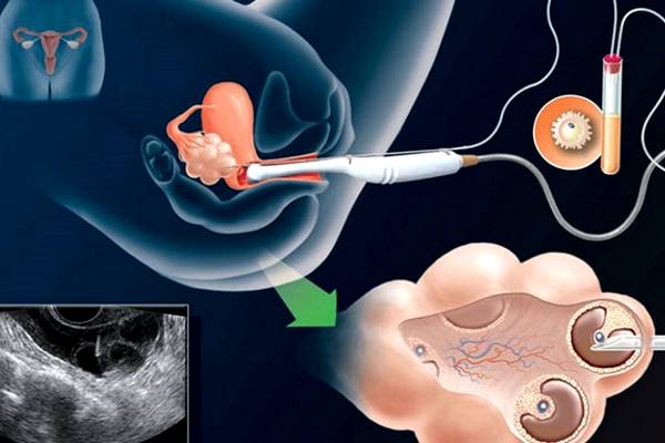 картинка экстракорпорального оплодотворения