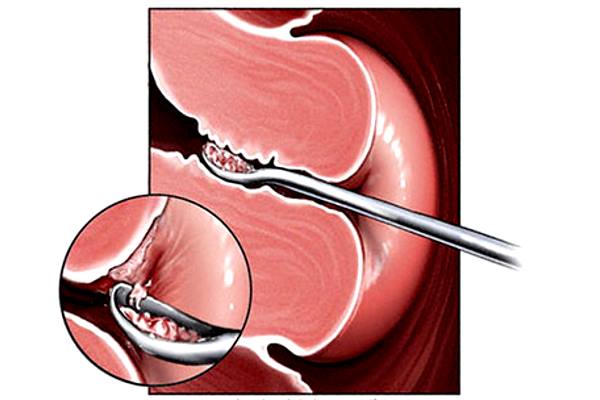 чистка слизистой кюреткой