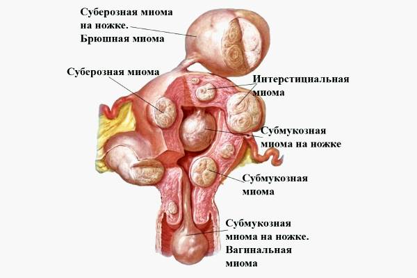новообразование на женском детородном органе